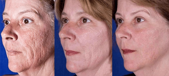 Rezultat nakon laserskog podmlađivanja kože lica