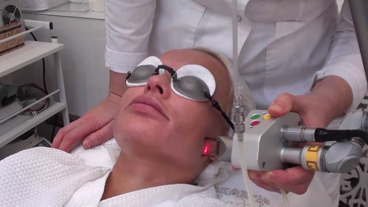 Tretman laserskim zrakom problematičnih područja kože lica