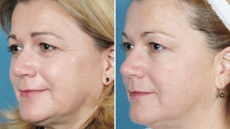 fotografije prije i nakon hardverskog podmlađivanja kože