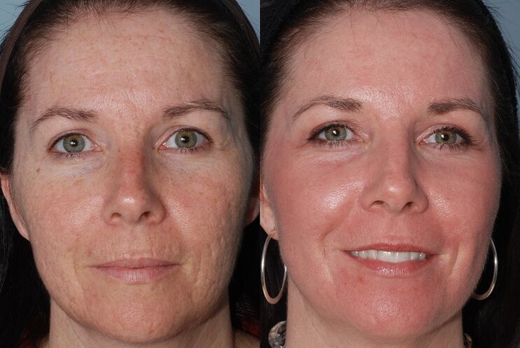 prije i poslije hardverskog podmlađivanja kože