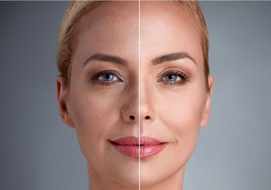 prije i poslije laserskog pomlađivanja lica