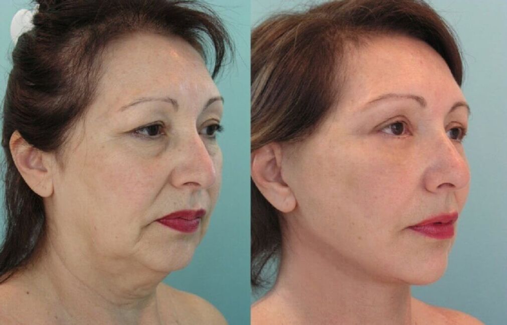 fotografija prije i poslije podmlađivanja kože