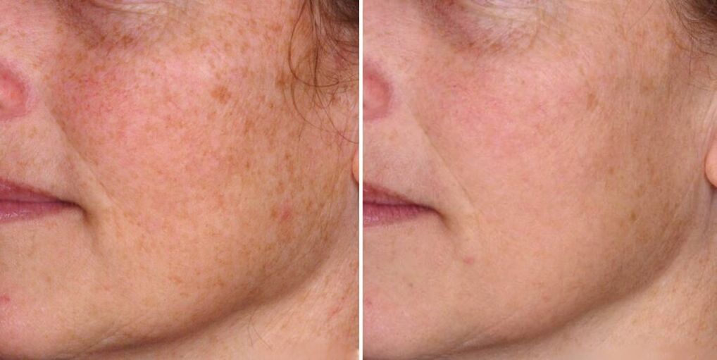 kože lica prije i poslije podmlađivanja